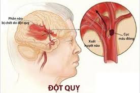 Đột quỵ - Ảnh minh họa